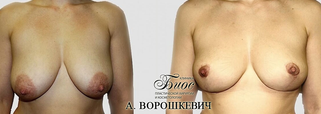 Результат подтяжки груди, мастопесии 14