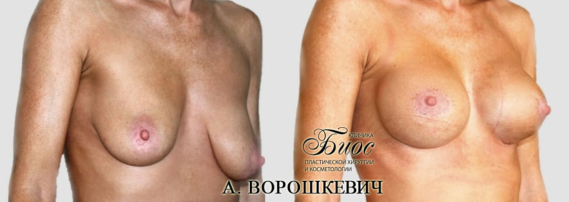 Результат подтяжки груди, мастопесии 16