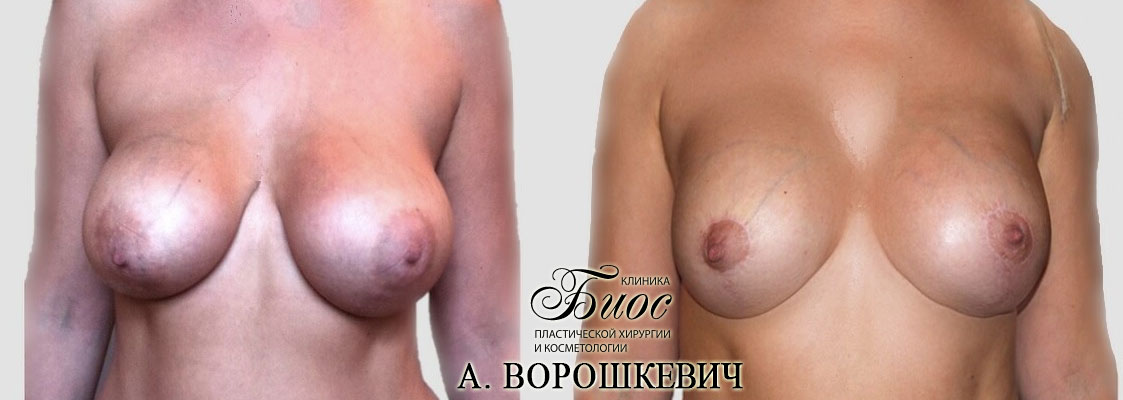 Результат подтяжки груди, мастопесии 22