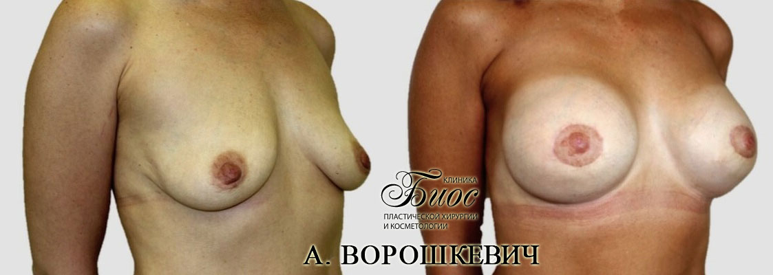 Результат подтяжки груди, мастопесии 3