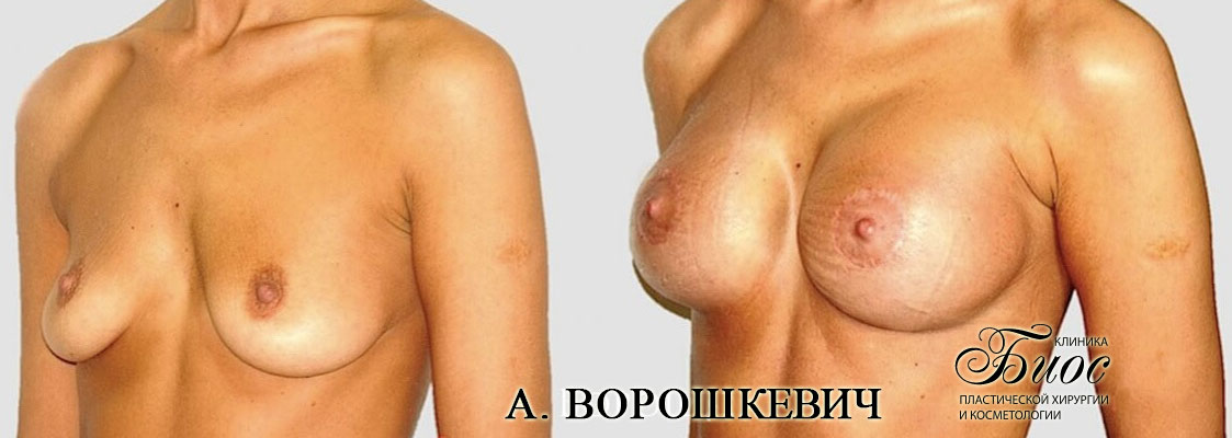 Результат подтяжки груди, мастопесии 5