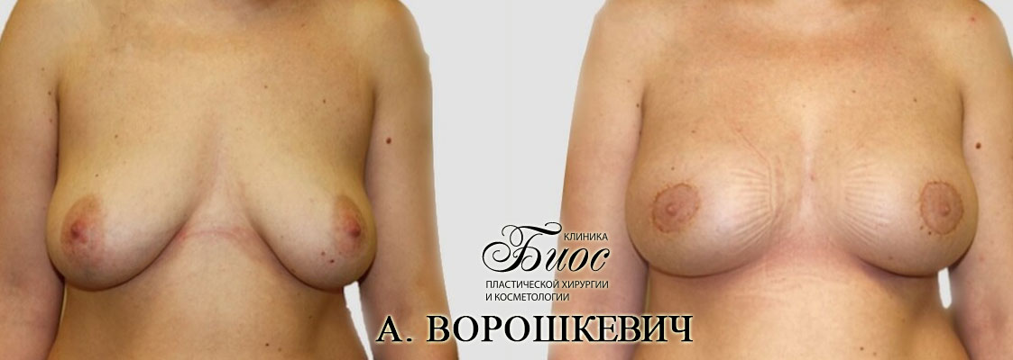 Результат подтяжки груди, мастопесии 8