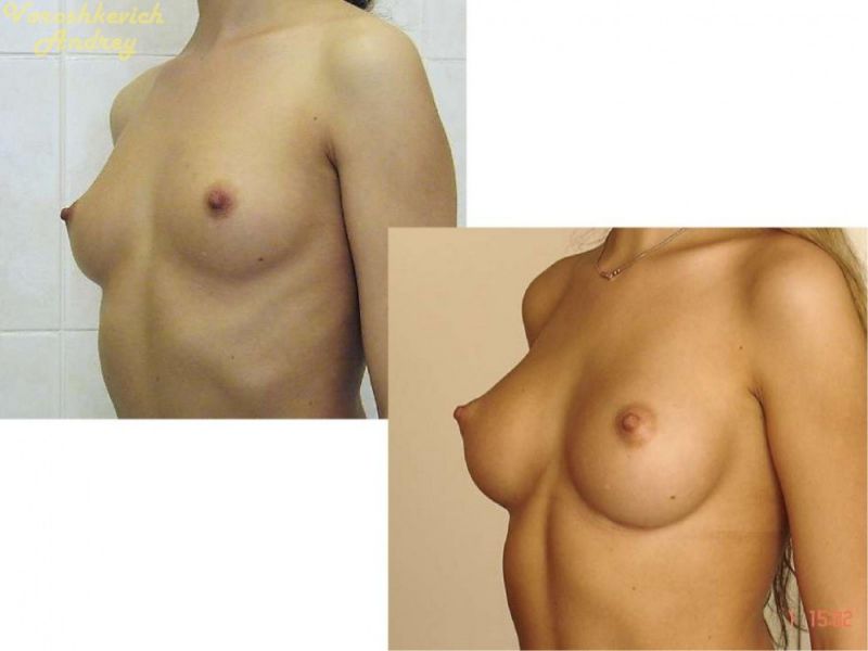 Результат операции увеличение груди 2