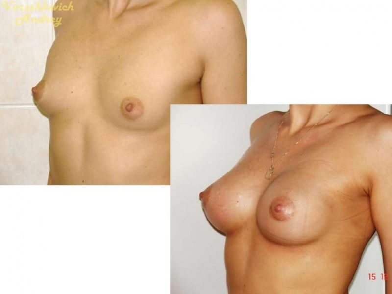 Результат операции увеличение груди 3