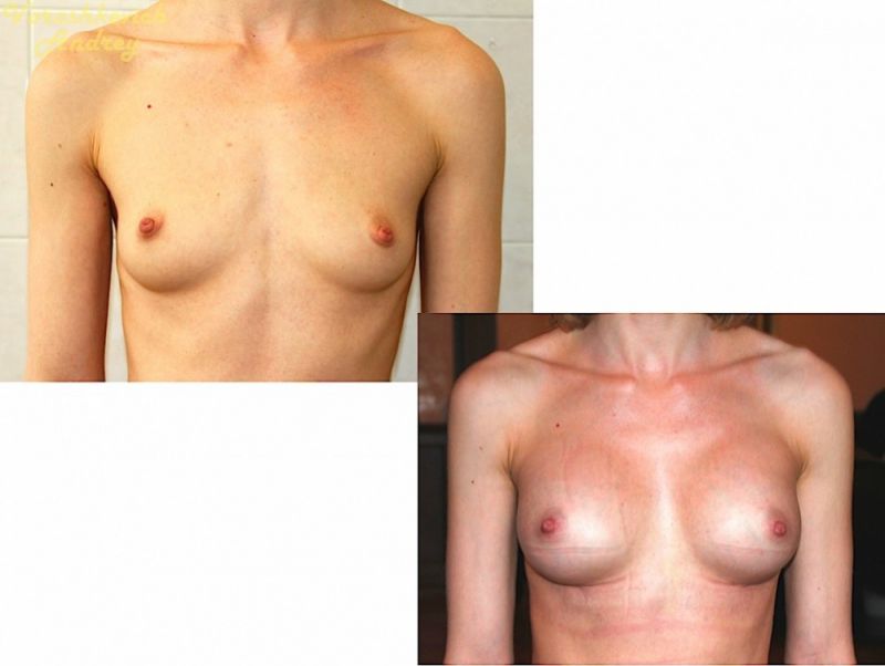 Результат операции увеличение груди 5