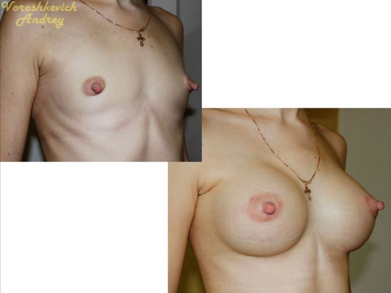 Результат операции увеличение груди 6