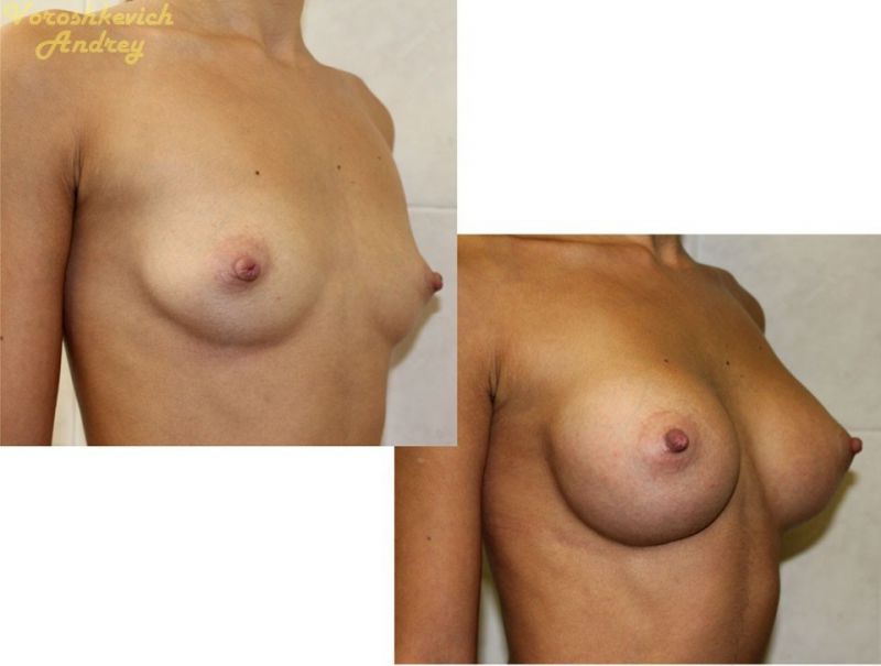 Результат операции увеличение груди 7
