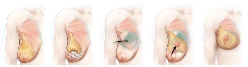 Операция по подтяжке груди с дополнительным применением имплантов