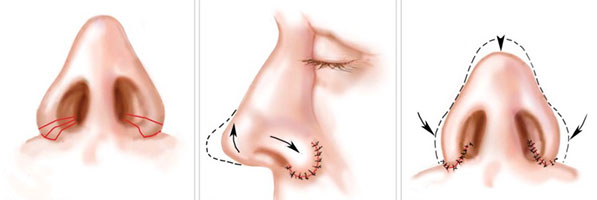 Ринопластика кончика носа