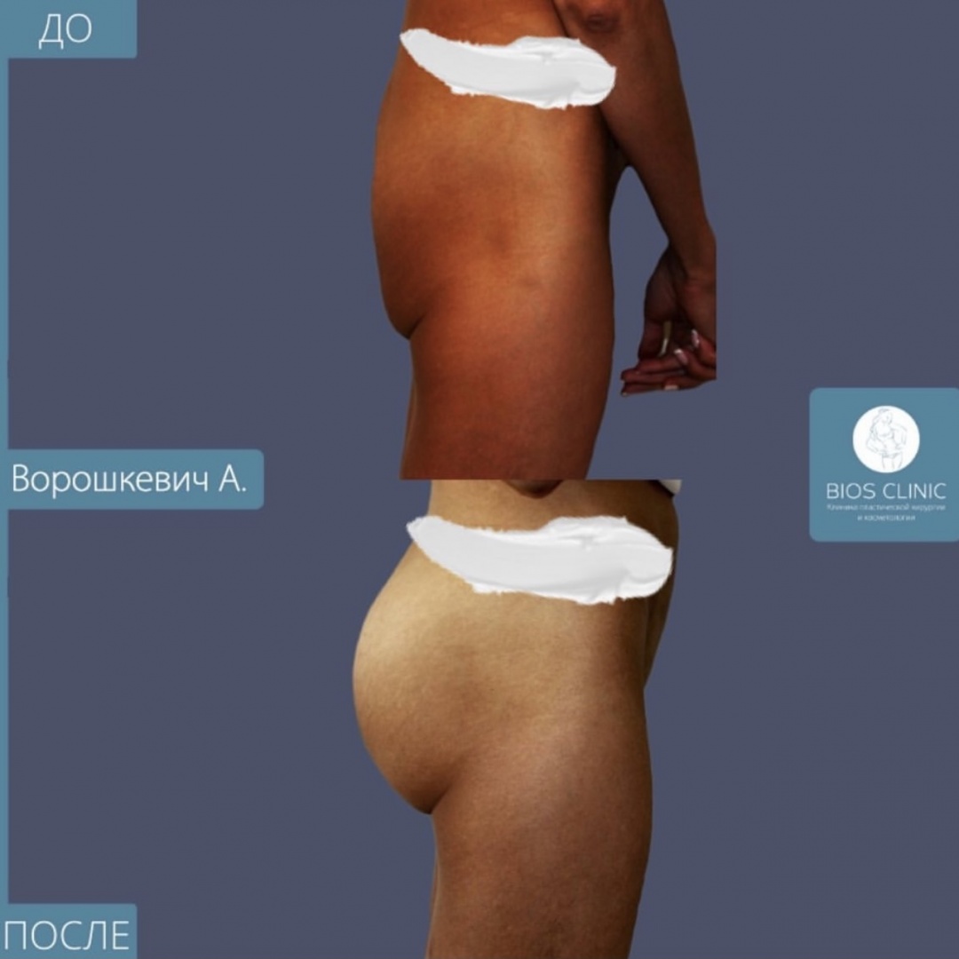 Увеличение ягодиц имплантами анатомической формы фотография 3