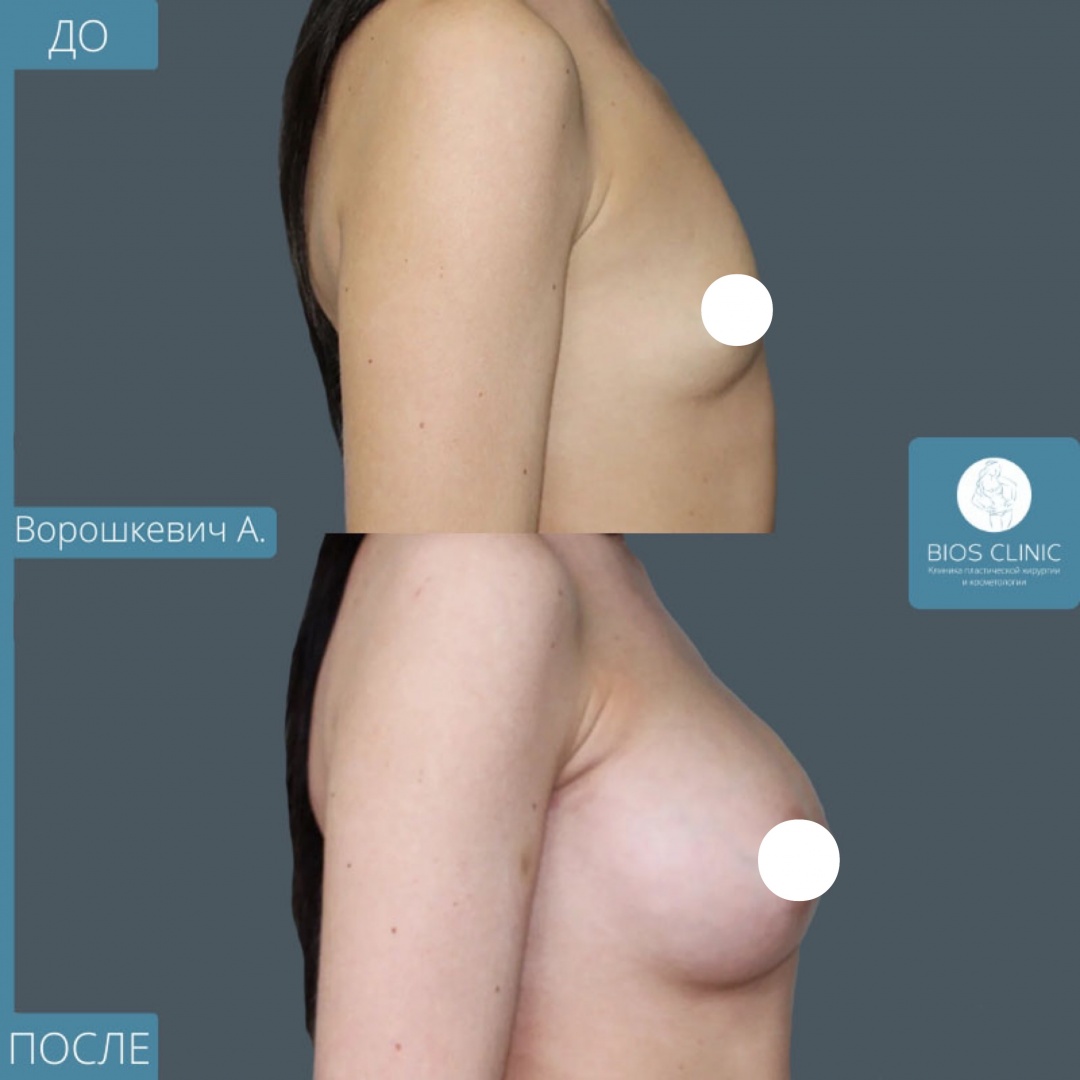Увеличение груди эндоскопическим методом фотография 2