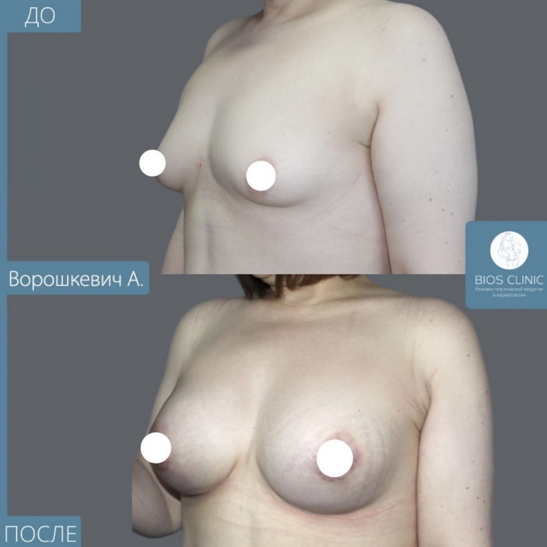 Увеличение груди  фотография 1