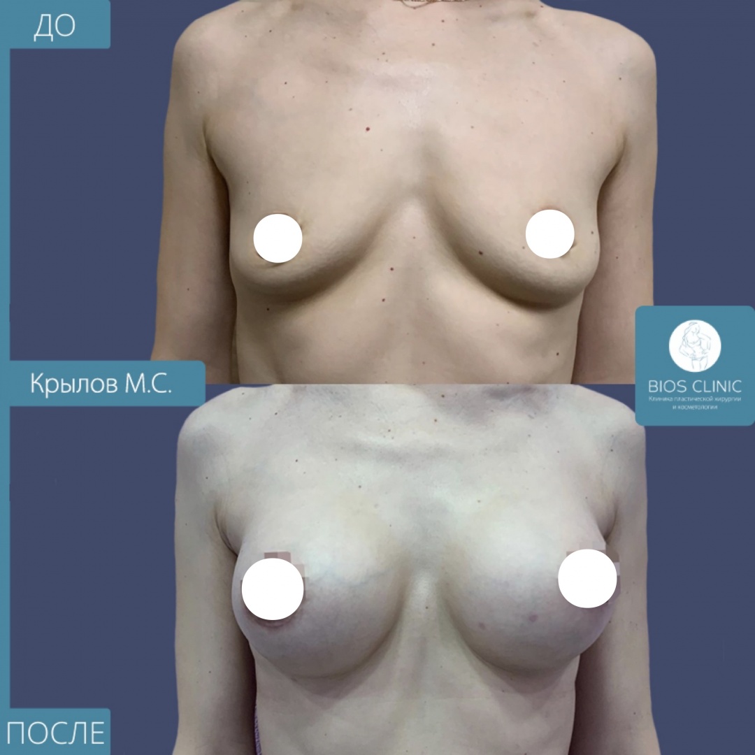 Увеличение груди круглыми имплантами, ареолярный доступ фотография 1