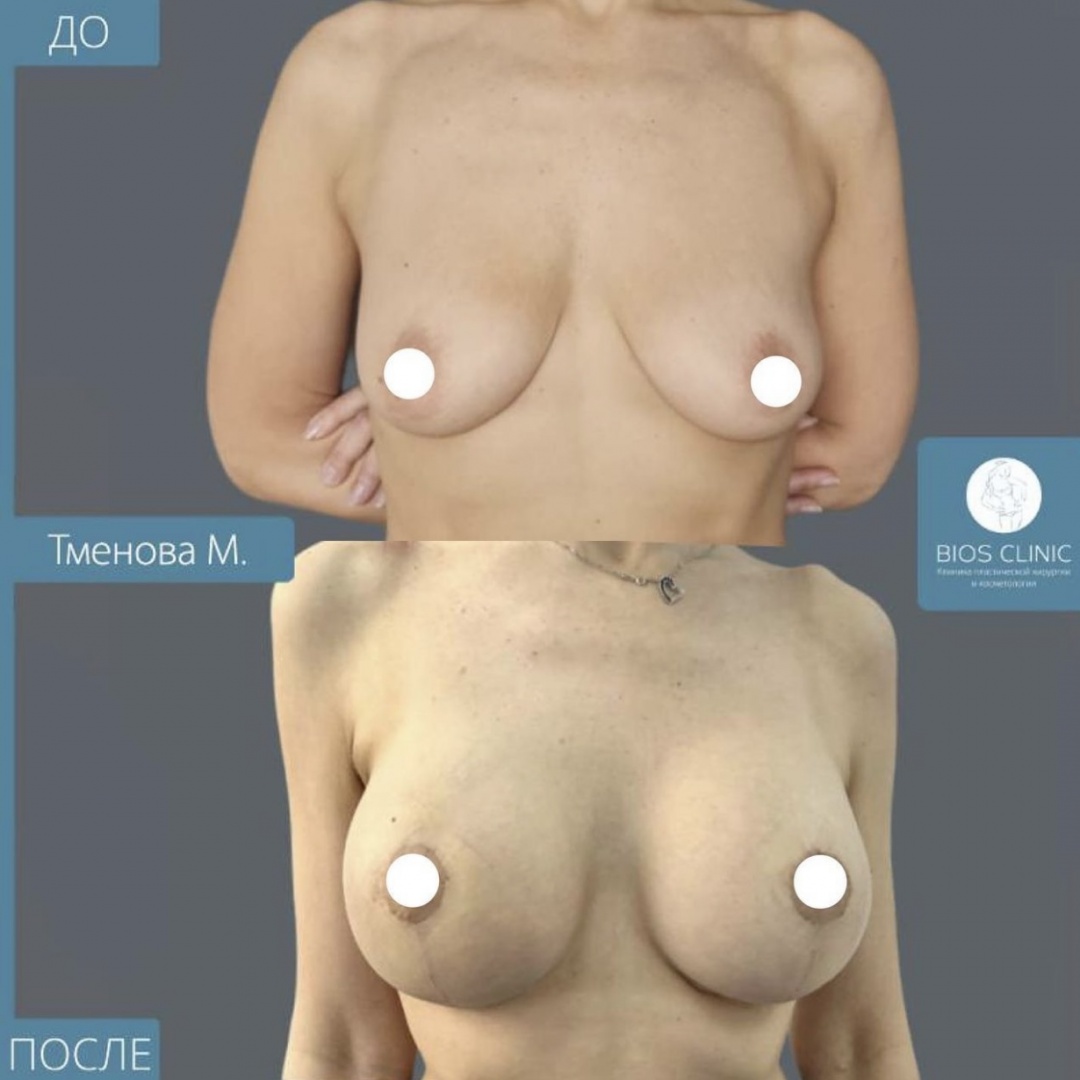 Увеличение груди имплантами с Т образной подтяжкой  фотография 2