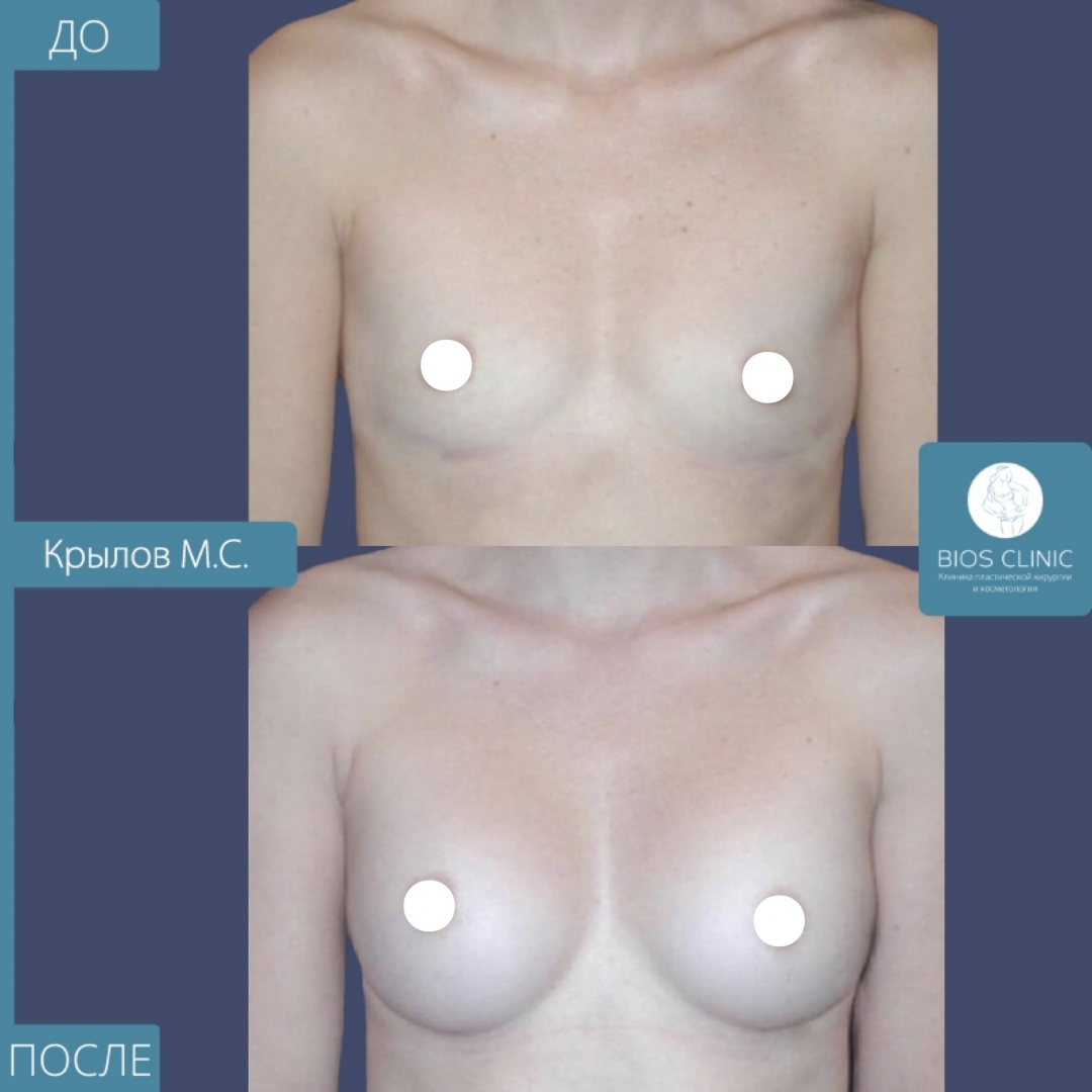 Увеличение груди анатомическими имплантами высокой проекции, субмаммарный доступ