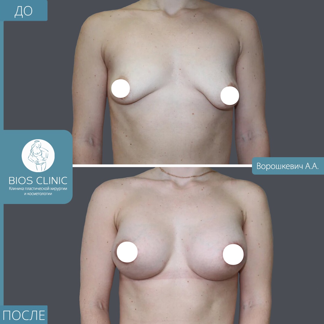 Увеличение груди анатомическими имплантами + периареолярная подтяжка