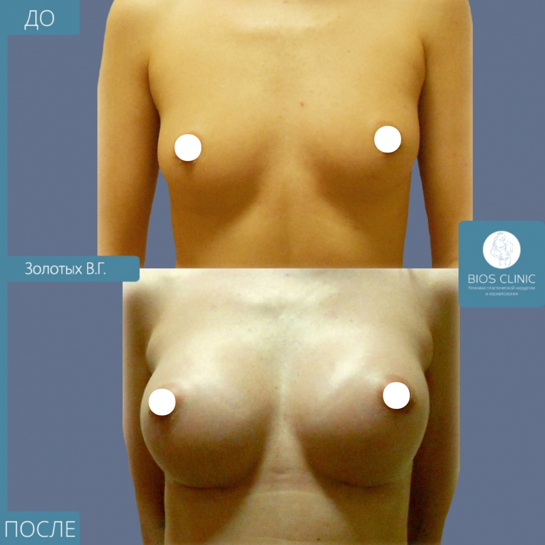 увеличение груди круглыми имплантами фотография 3