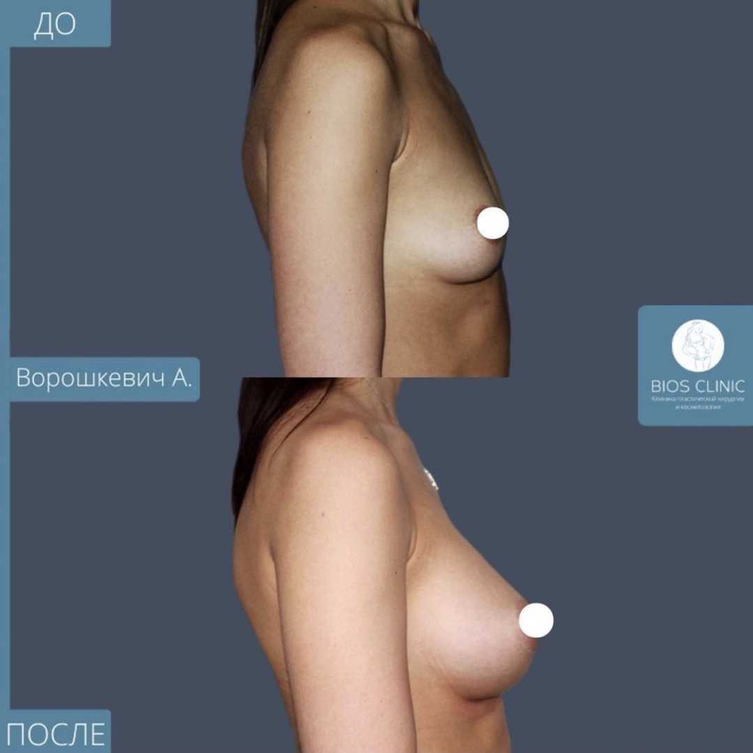 Увеличение груди фотография 2