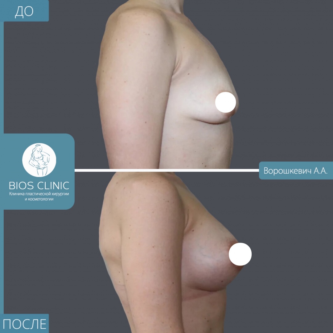 Увеличение груди анатомическими имплантами + периареолярная подтяжка фотография 2