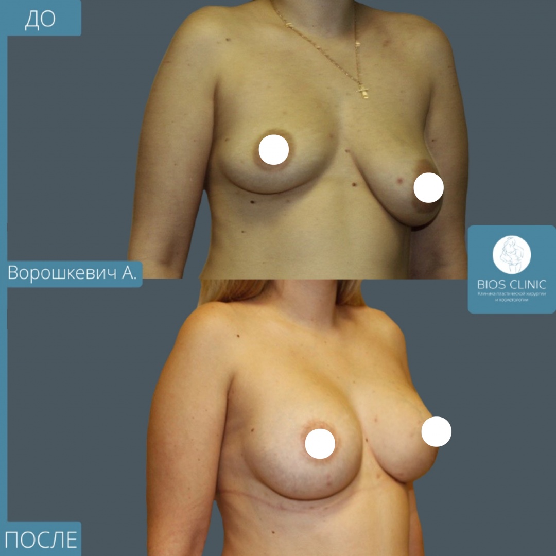 Подтяжка груди на имплантах фотография 3