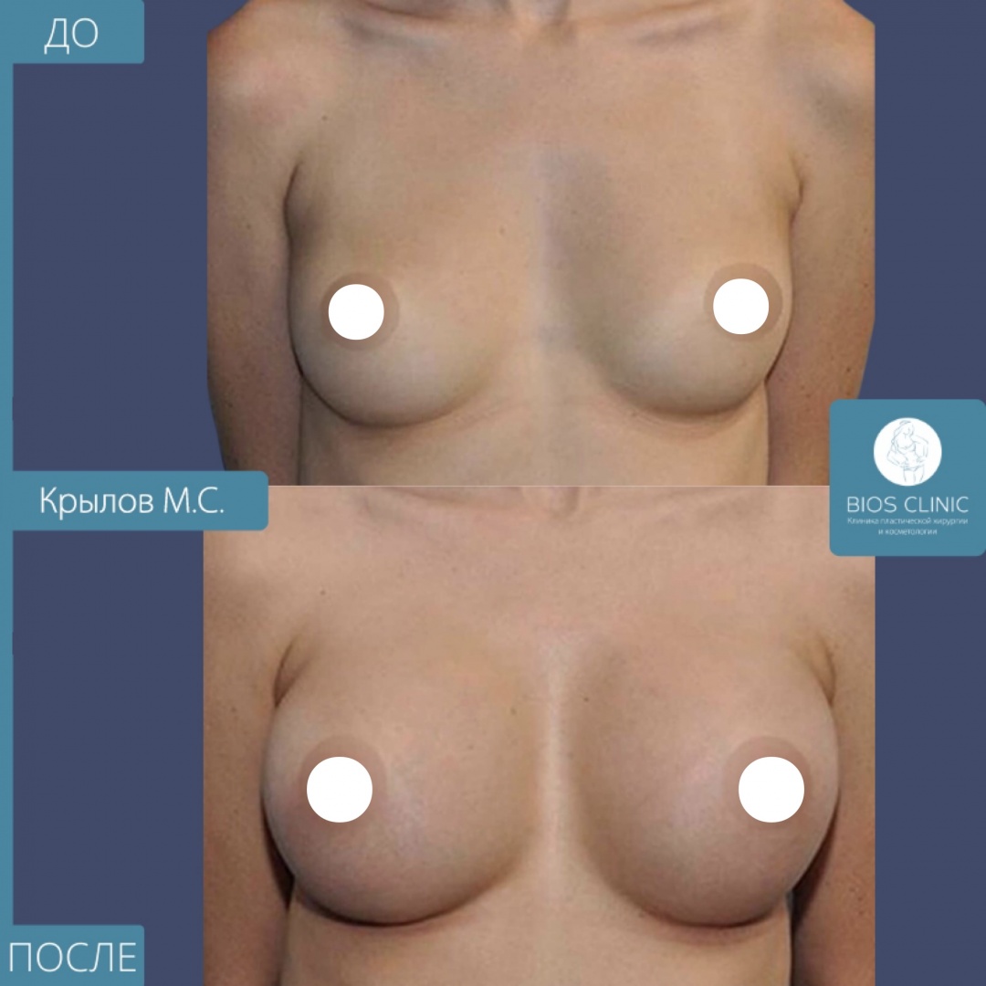 Увеличение груди круглыми имплантами, субмаммарный доступ фотография 1