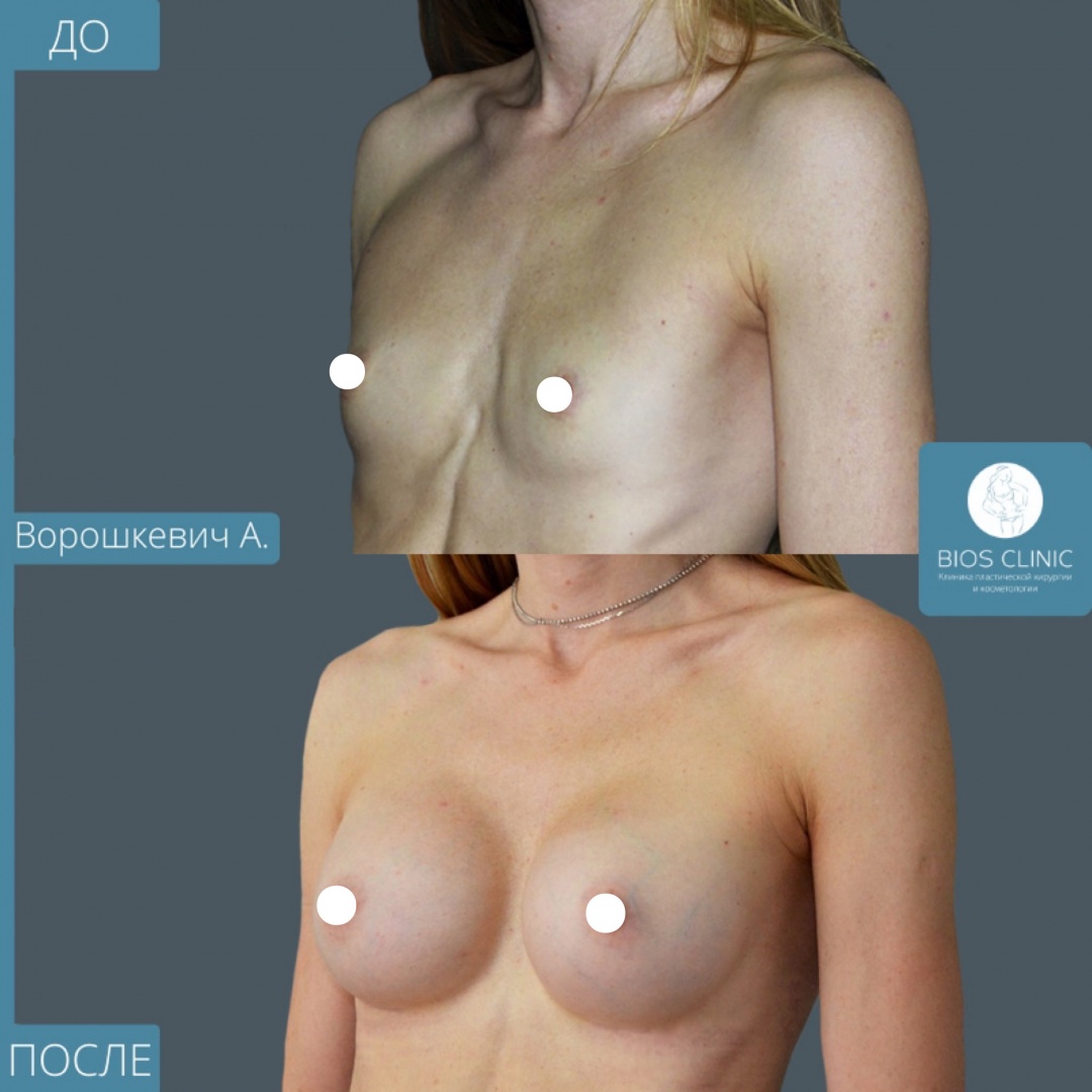 Увеличение груди фотография 4