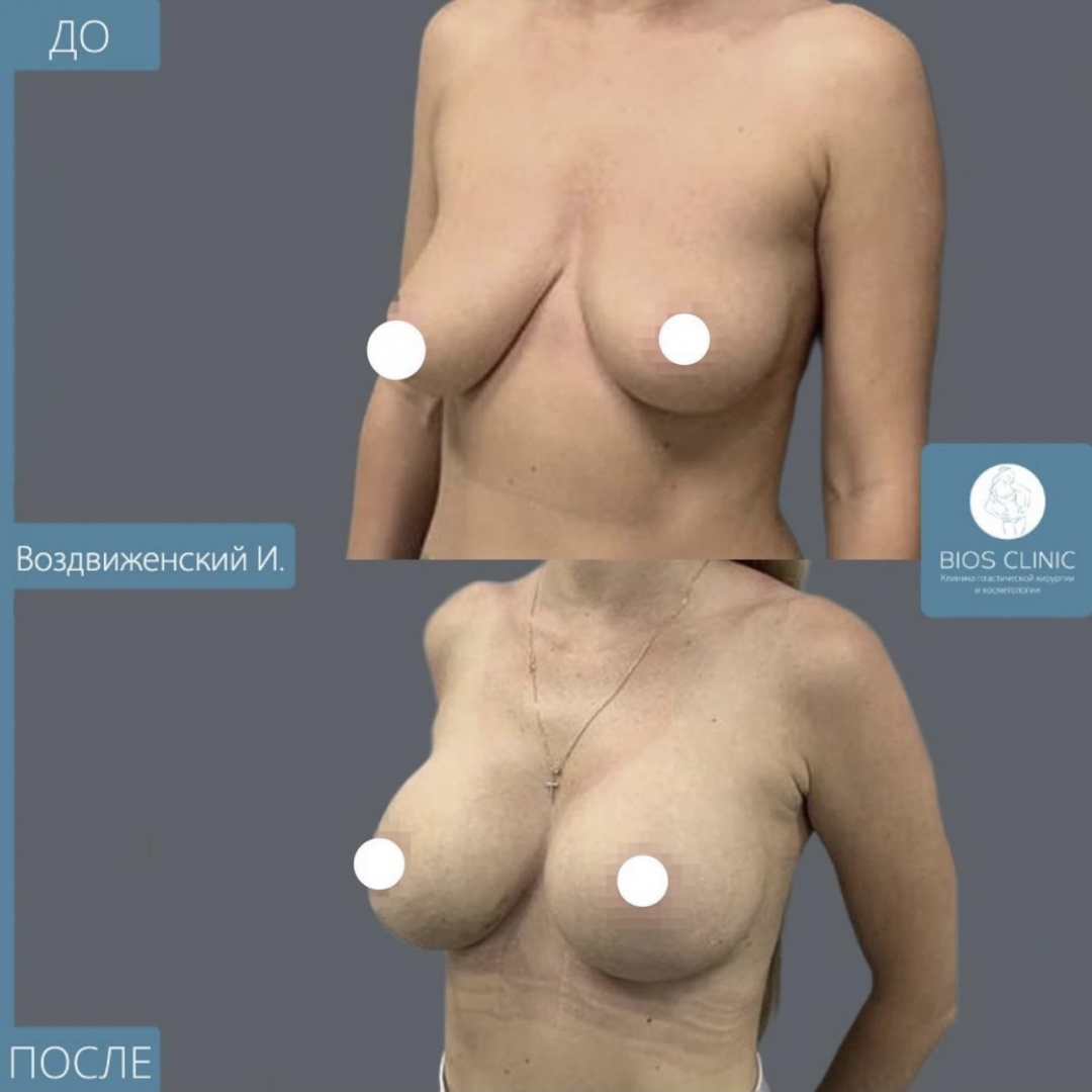 Увеличение груди с коррекцие асиметрии фотография 1