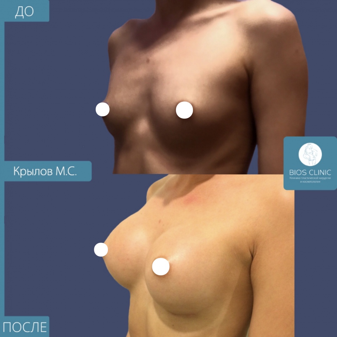 Увеличение груди сверхвысокими круглыми имплантами фотография 2