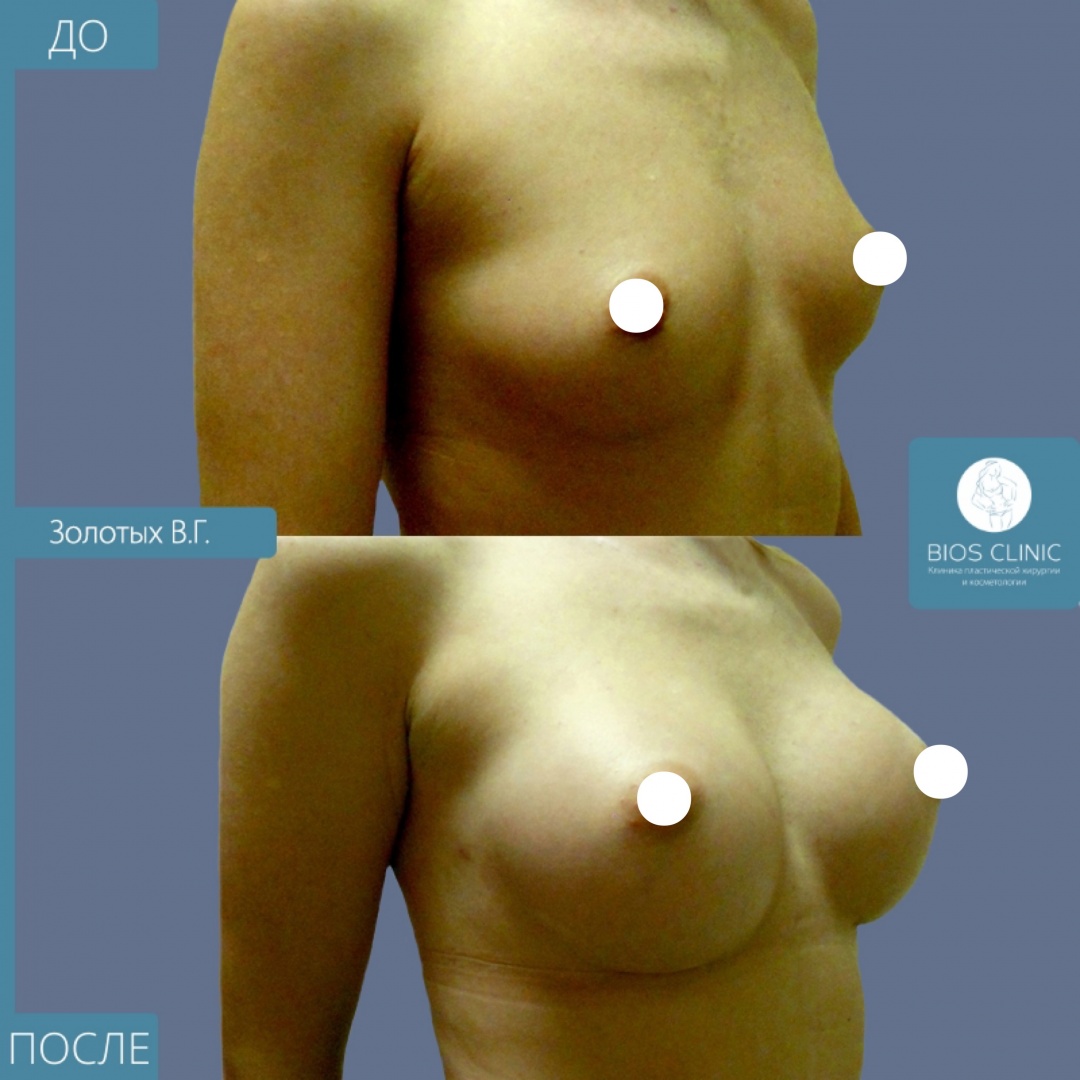 увеличение груди круглыми имплантами фотография 2