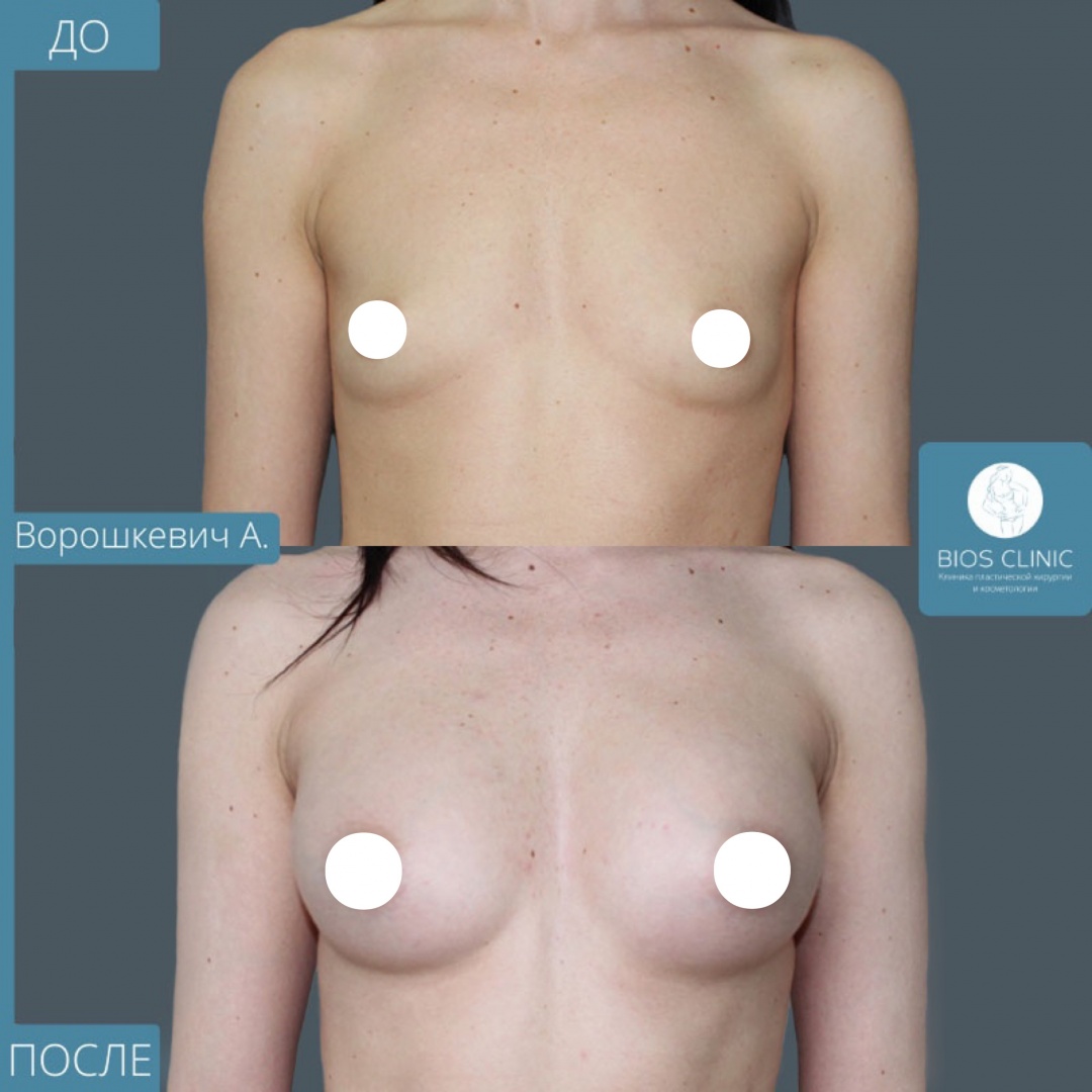 Увеличение груди эндоскопическим методом фотография 4