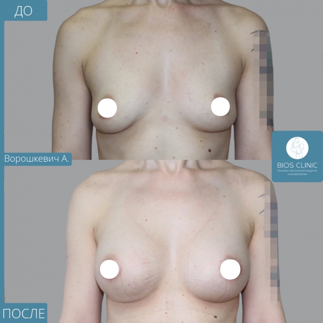 Увелиение груди ареолярный доступ фотография 2