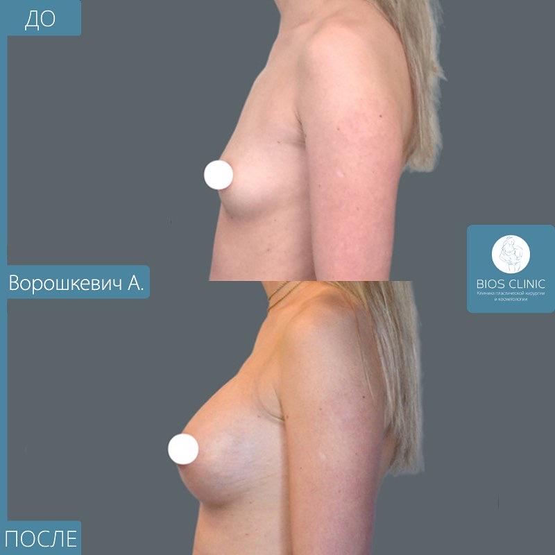 Увеличение груди анатомическими имплантам фотография 2