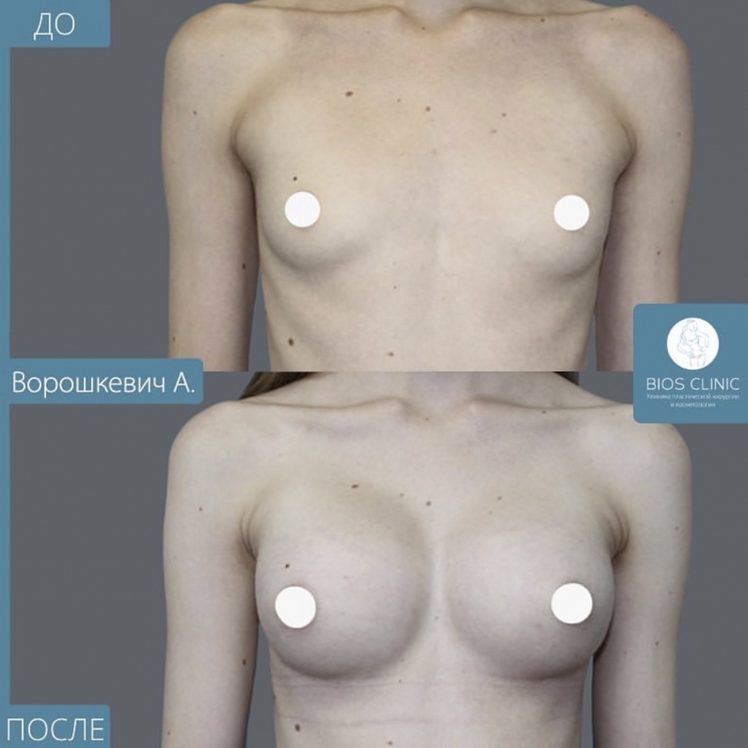 Увеличение груди фотография 1