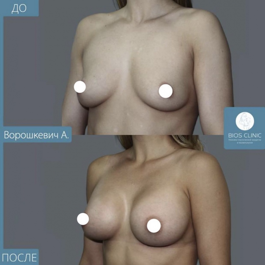 Увеличение груди через 2 месяца фотография 2