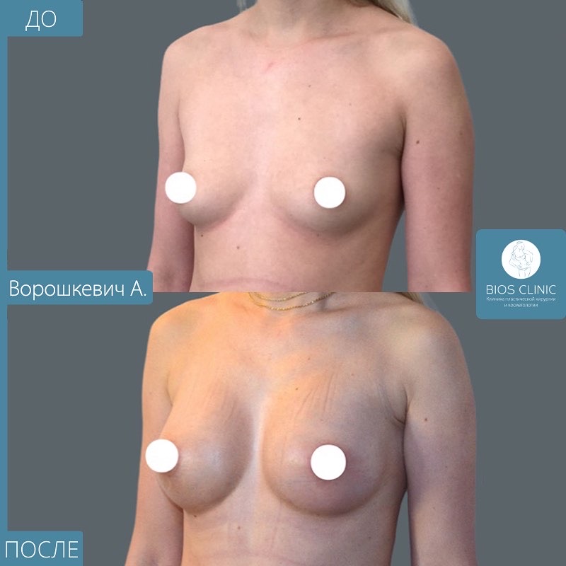 Увеличение груди анатомическими имплантам фотография 3