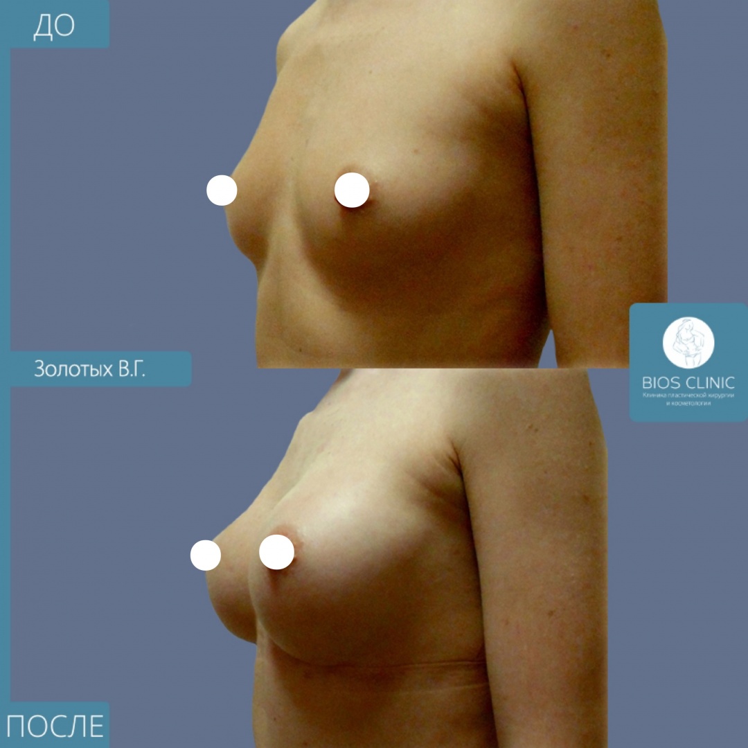 увеличение груди круглыми имплантами