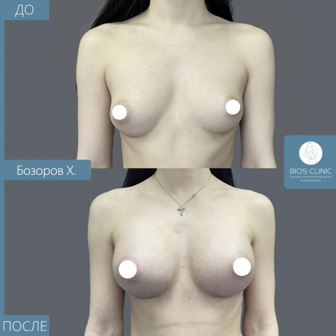 Увеличение груди фотография 2