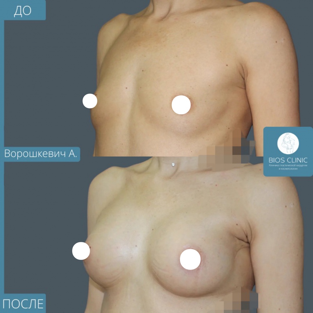Увеличение груди эндоскопическим доступом фотография 3
