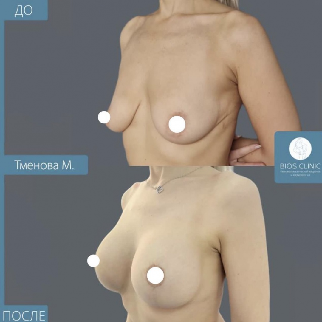 Увеличение груди имплантами с Т образной подтяжкой  фотография 3