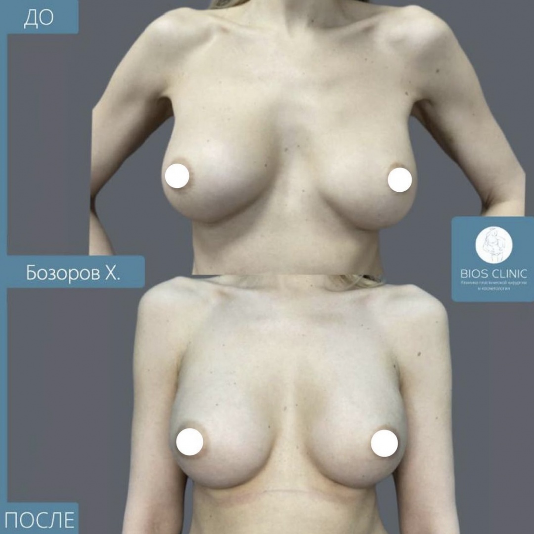 Реэндопротезирование молочных желёз (замена грудных имплантов)  фотография 2