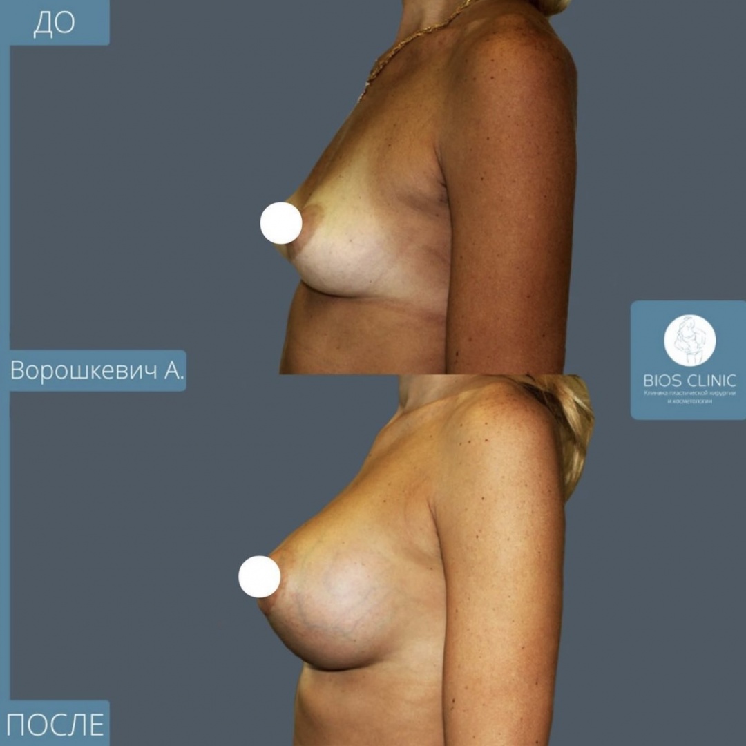 Увеличение груди через 5 месяцев фотография 2