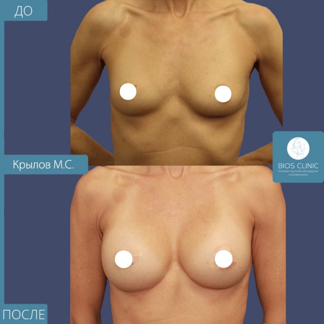 Увеличение груди анатомическими имплантами, субмаммарный доступ