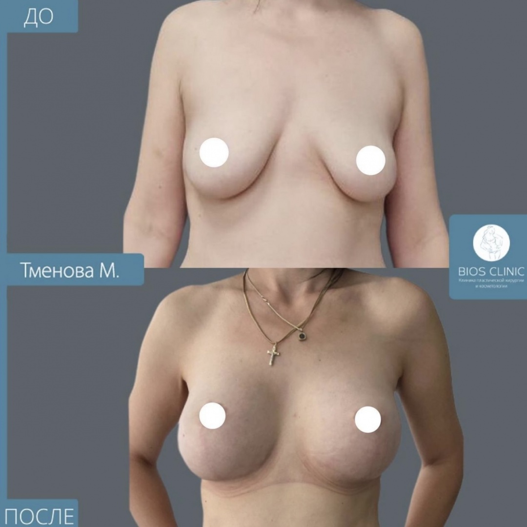 Увеличение груди с Т образной подтяжкой  фотография 2