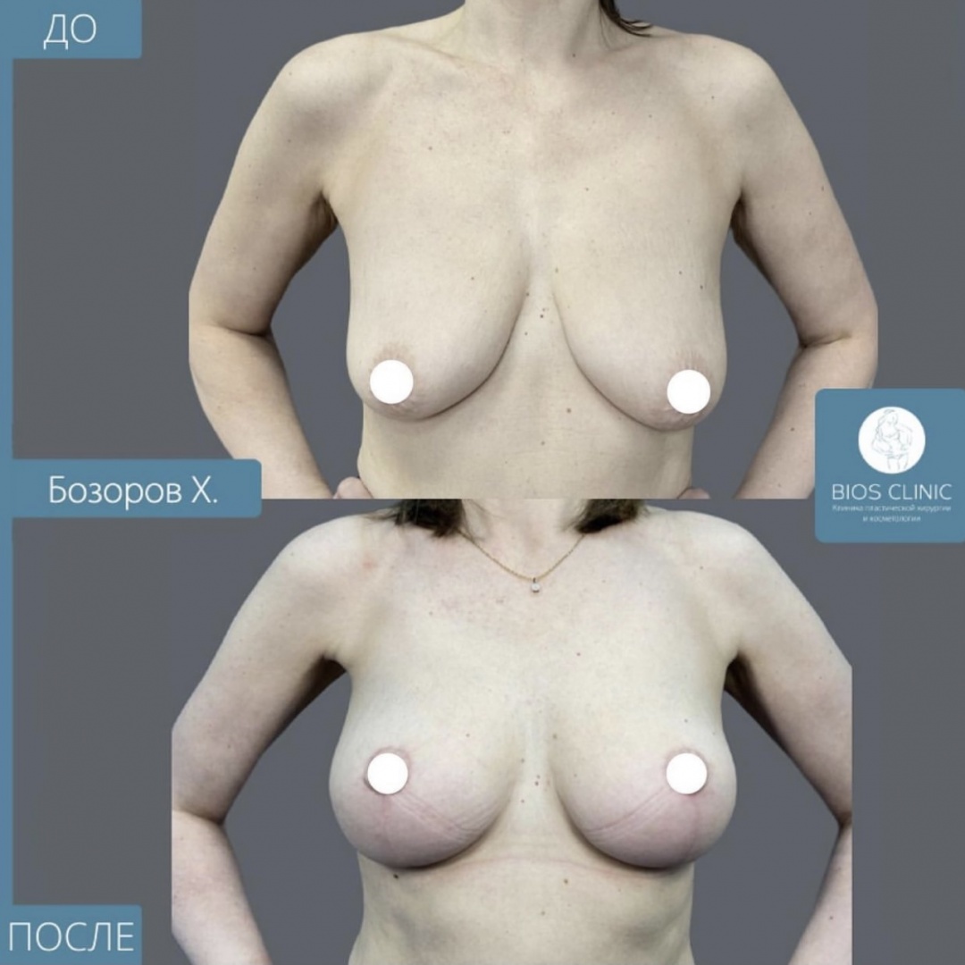 Подтяжки груди без имплантов фотография 3