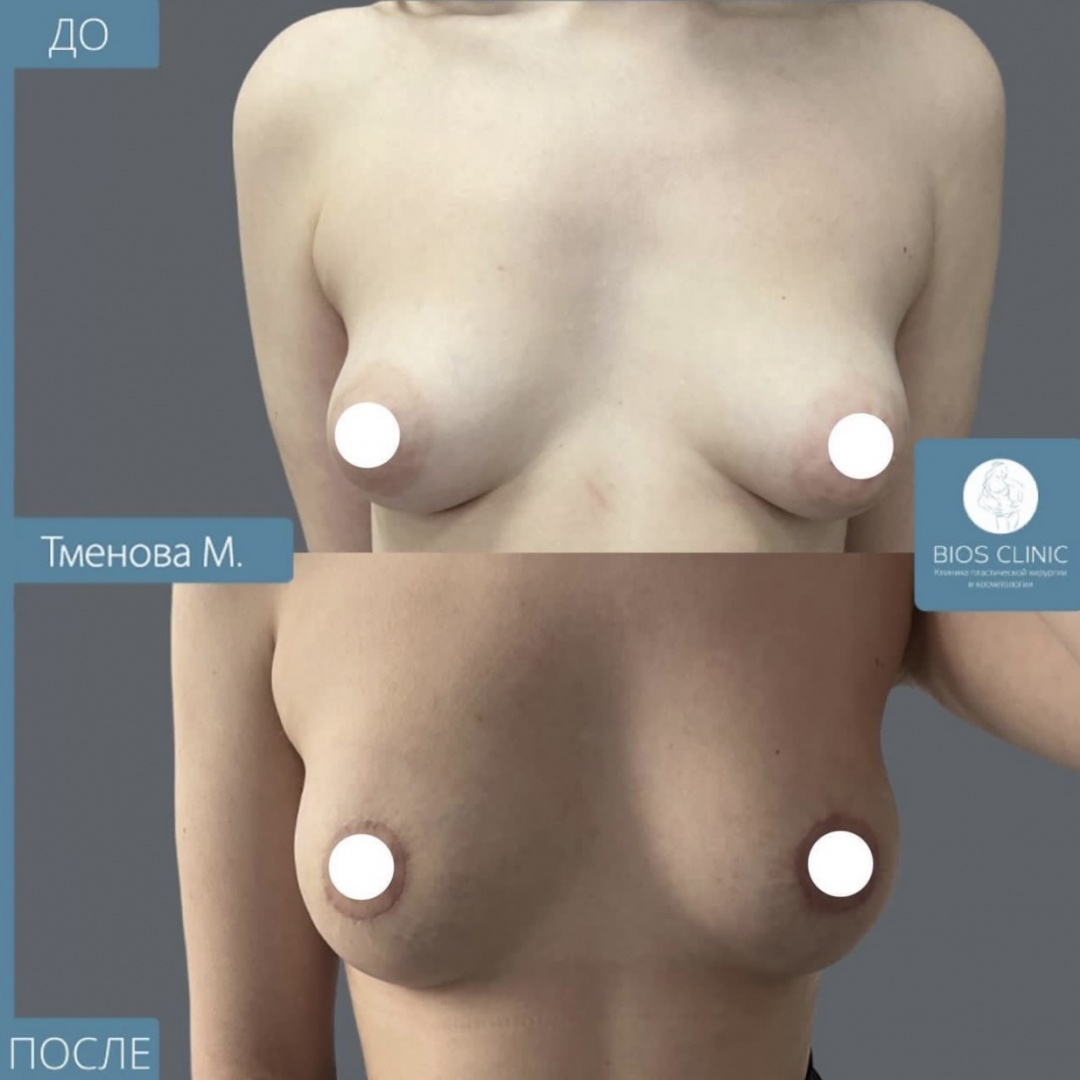 Подтяжка груди по ареоле без имплантов фотография 1