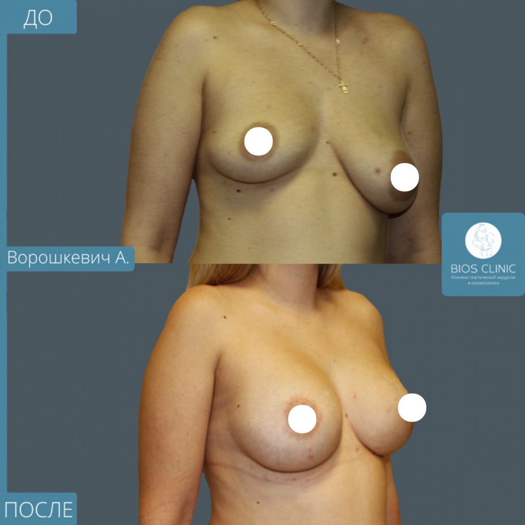 Подтяжка груди на имплантах фотография 1