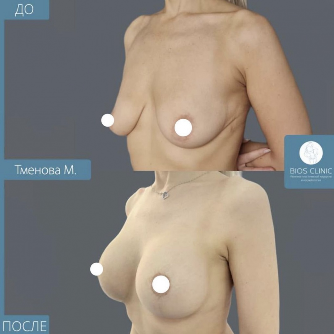 Подтяжка груди Т образная фотография 1