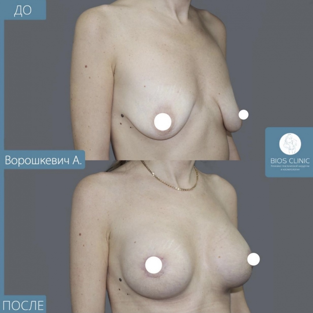 Увеличение груди + подтяжка по ареоле