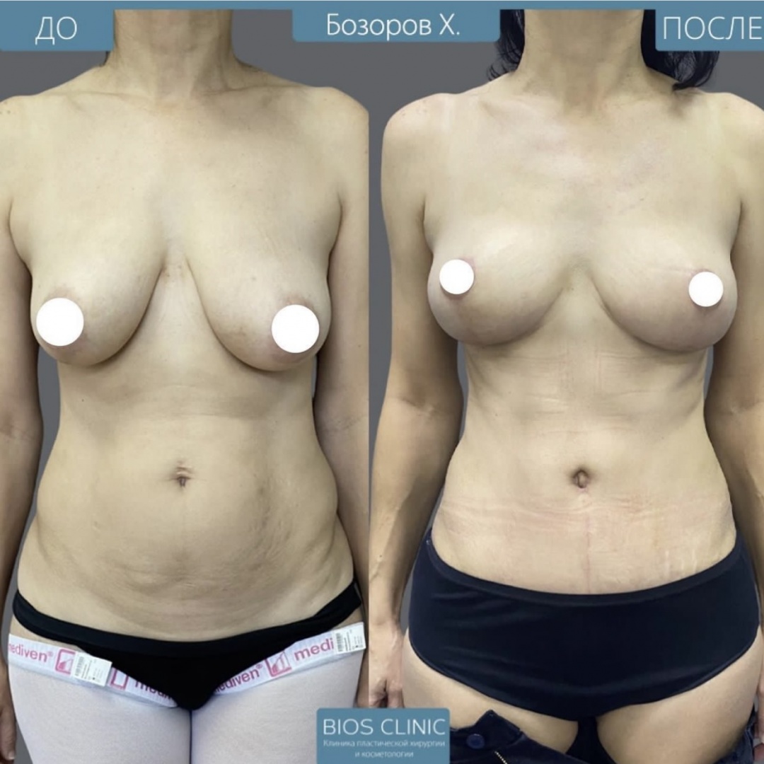 Подтяжка груди с эффектом импланта, абдоминопластика и липосакция боков фотография 1