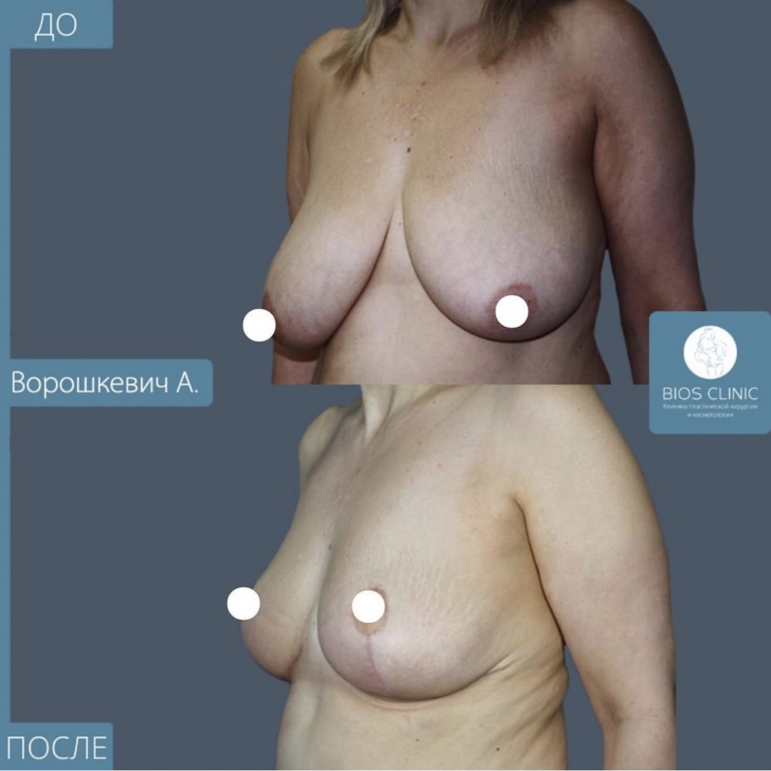 Уменьшение груди фотография 2